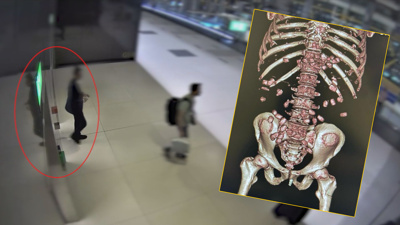 Midesinden kapsül kapsül uyuşturucu çıktı