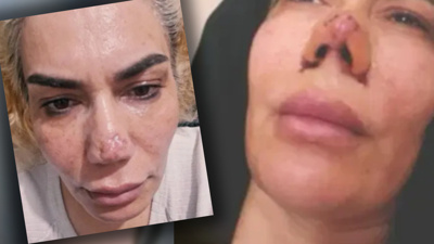 Burnunun yarısı yırtıldı: Estetik yaptırdığına bin pişman oldu