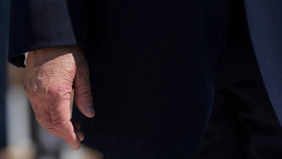 Trump’ın elindeki gizemli morluklar yeniden ortaya çıktı! Makyaj da gizleyemedi