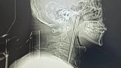 Çoğu insan saniyeler bile dayanamazdı: 12 santimetreyle tam 8 yıl yaşadı