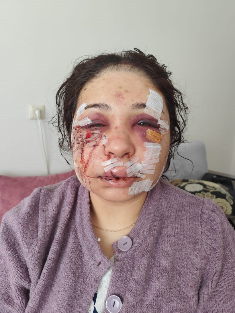 Eşinin yüzünü parçalayan polise ödül gibi ceza verildi! Tırnak makası ile kesti... - Resim : 2