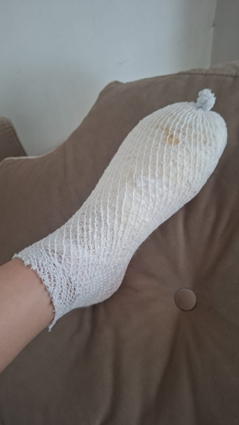 Mağazadan alınan oyuncak elinde patladı! '2'nci derece yanık oluştu' - Resim : 4