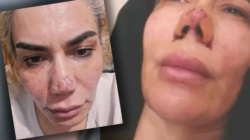 Burnunun yarısı yırtıldı: Estetik yaptırdığına bin pişman oldu