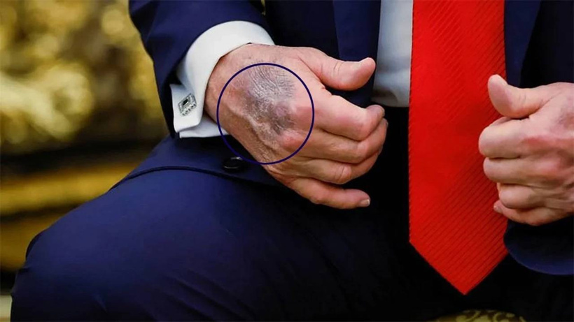 Trump'ın hastalığı belli oldu! Morlukları bu yüzden geçmiyormuş