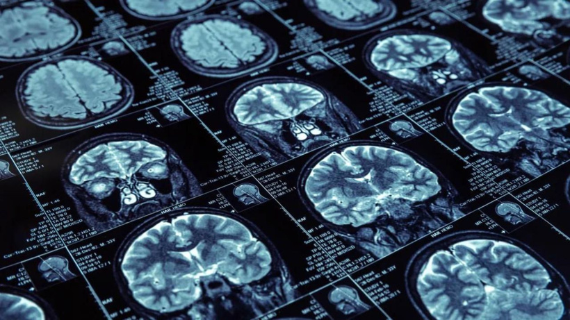 Yaşlılıkta alzheimer korkusuna çare: Demans 3 alışkanlıkla 13 yıl geciktirilebilir