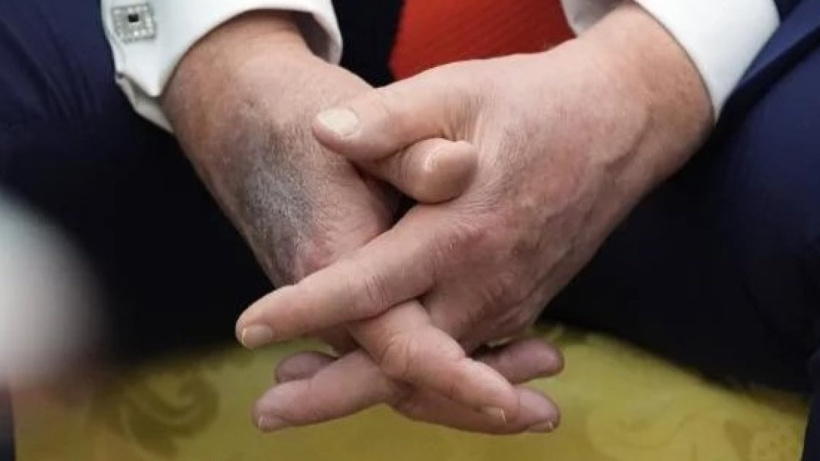 Elindeki morluklar yine görüldü: Trump’ın sağlık durumu açıklandı