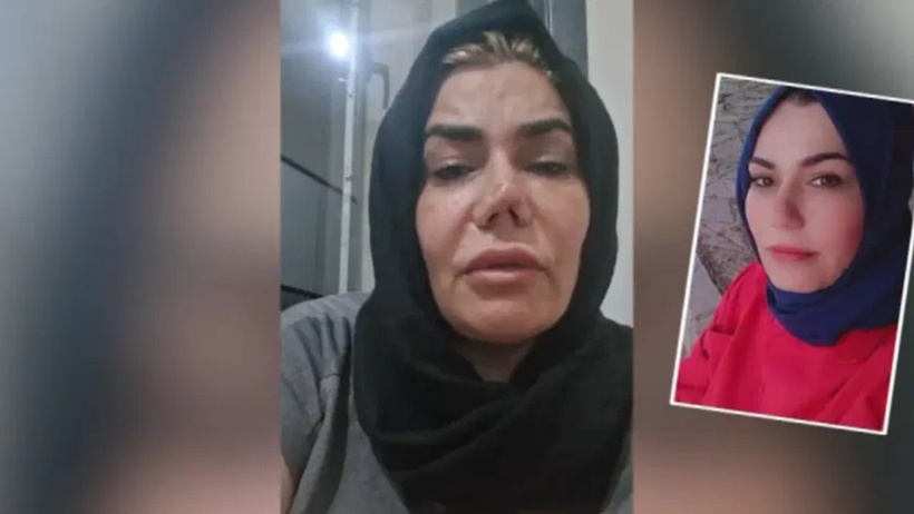 Burnunun yarısı yırtıldı: Estetik yaptırdığına bin pişman oldu - Resim : 3