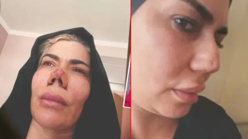 Burnunun yarısı yırtıldı: Estetik yaptırdığına bin pişman oldu - Resim : 1